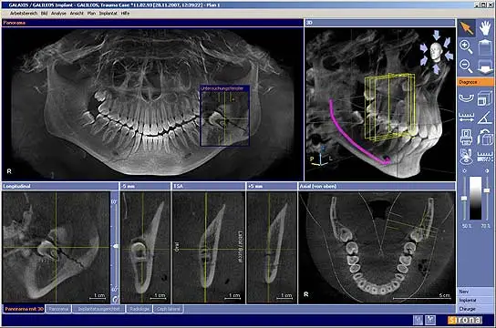 3D CBCT cone beam scan showing full jaw model with teeth, nerves, bone and sinuses — in-office at Merry Dental Hub Wylie TX 75098