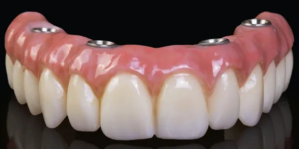 All-on-4 hybrid dental implant prosthesis at Merry Dental Hub — full arch of porcelain teeth with titanium implant abutment connectors, permanent fixed arch replacement on 4 implants by UCSF-trained Dr. C DDS in Wylie TX 75098 serving Wylie, Murphy, Sachse, Richardson, Garland, Rowlett, Lavon, Lucas, St. Paul and Plano TX