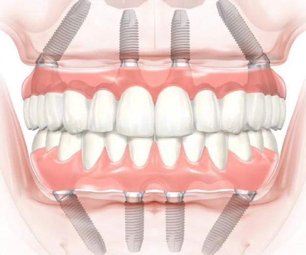All-on-4 dental implant angulation diagram at Merry Dental Hub — 3D illustration showing 4 titanium implant posts with angled posterior implants at 30-45 degrees supporting a full arch fixed prosthesis of 12-14 porcelain teeth — by UCSF-trained Dr. C DDS in Wylie TX 75098