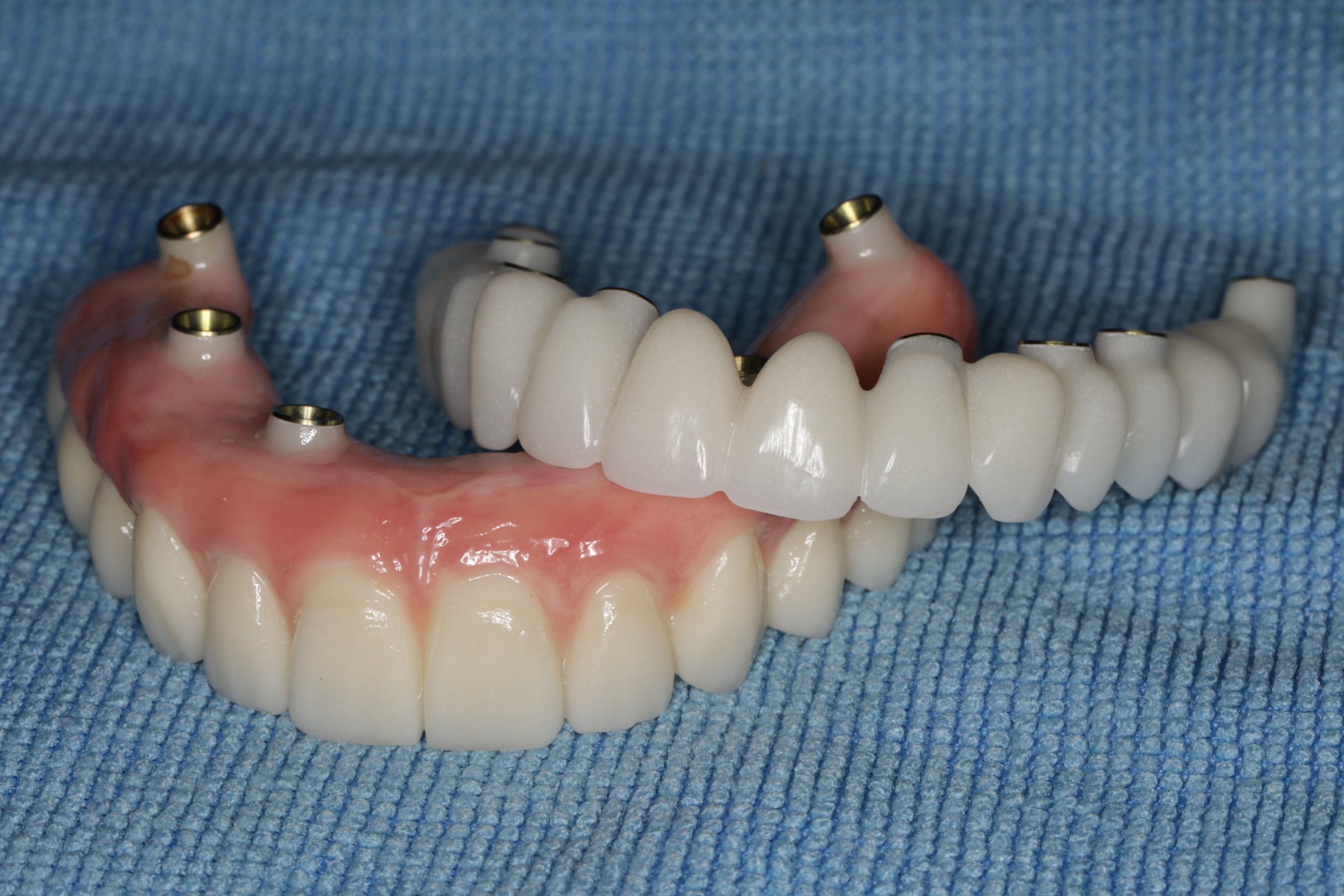 Implant hybrid full arch prosthesis for full mouth reconstruction at Merry Dental Hub — upper and lower arch supported by titanium implant posts with porcelain teeth and gum-colored acrylic, permanent fixed teeth replacement by UCSF-trained Dr. C DDS in Wylie TX 75098 serving Wylie, Murphy, Sachse, Richardson, Garland TX