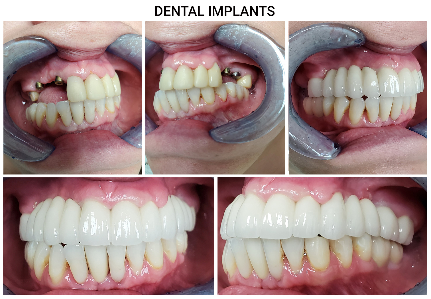 Implant-supported bridge 3D illustration at Merry Dental Hub — two titanium implant posts placed in jawbone supporting a 3-unit porcelain bridge to replace 2-4 consecutive missing teeth permanently, no grinding of adjacent teeth required — by UCSF-trained Dr. C DDS in Wylie TX 75098 serving Wylie, Murphy, Sachse, Richardson, Garland TX