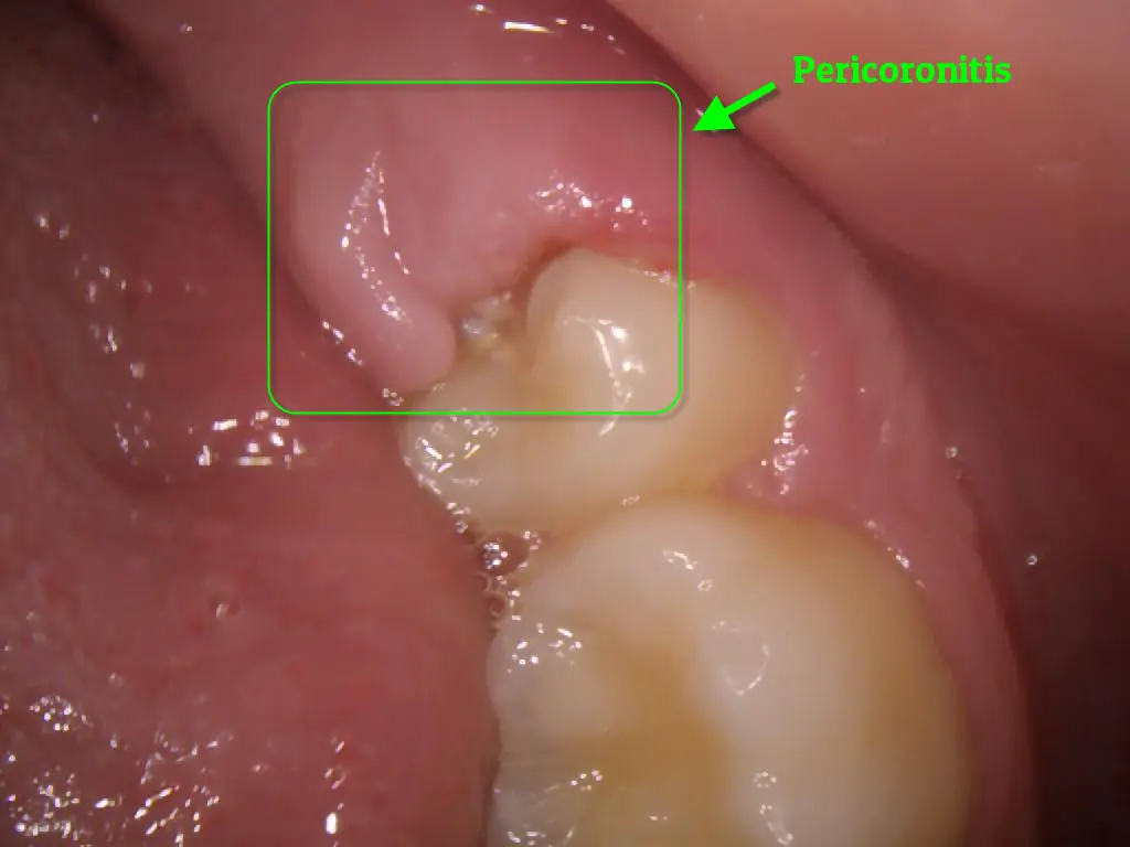 Pericoronitis — gum infection around partially erupted wisdom tooth at Merry Dental Hub Wylie TX