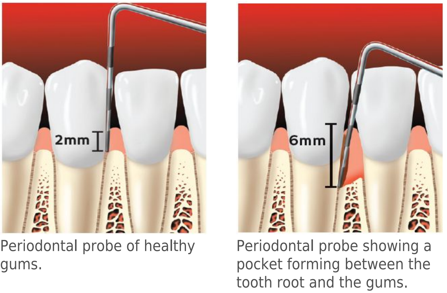 Periodontal probe comparison — 2mm healthy gum pocket (left) vs 6mm diseased pocket with gum recession (right). Dr. C uses periodontal probing at every comprehensive exam at Merry Dental Hub, Wylie TX 75098