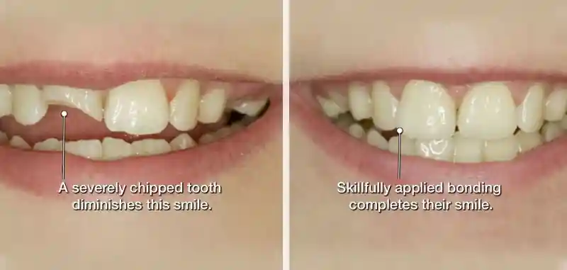 Cosmetic dental bonding to repair chips and gaps at Merry Dental Hub — Wylie TX 75098