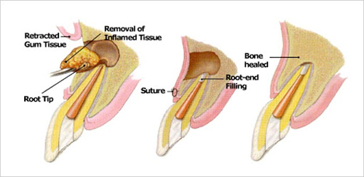 Apicoectomy anatomy diagram showing retracted gum tissue, removal of inflamed root tip, root-end filling placement, and bone healing in Wylie TX