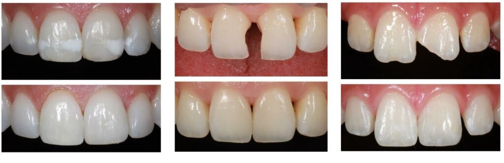 BPA-free composite white tooth-colored fillings — mercury-free restorations at Merry Dental Hub Wylie TX