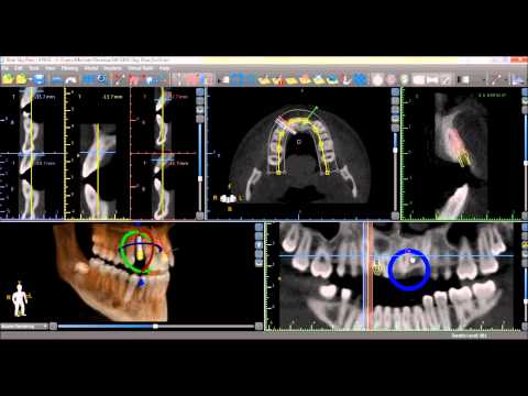 Computer-guided dental implant planning software at Merry Dental Hub — 3D CBCT cone beam scan showing precise implant positioning with cross-sectional views, panoramic X-ray, and digital measurement guides used by UCSF-trained Dr. C DDS in Wylie TX 75098 for single dental implant placement — serving Wylie, Murphy, Sachse, Richardson, and East DFW