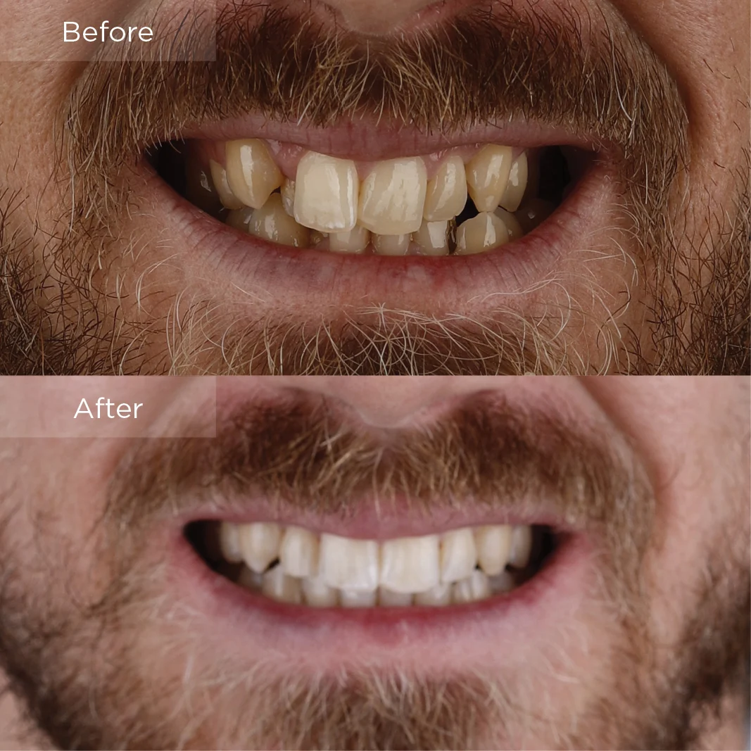 Crowded teeth before and after clear aligner treatment at Merry Dental Hub Wylie TX — adult patient upper and lower crowding corrected in 14 months. Photographed with written patient consent.
