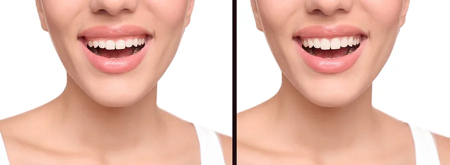 Crown lengthening before and after photo at Merry Dental Hub Wylie TX — patient's smile before shows excess gum tissue covering the natural tooth length; after photo shows balanced gumline and full tooth proportions revealed by Dr. C's crown lengthening procedure