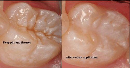 Dental sealant being applied to a child's molar tooth at Merry Dental Hub — protective coating seals deep grooves to prevent cavities and tooth decay in Wylie TX 75098