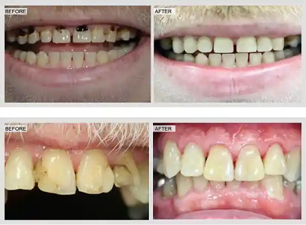 Real before and after dental bonding cases at Merry Dental Hub — chipped, gapped and stained teeth restored with same-day composite resin bonding by Dr. C, Wylie TX
