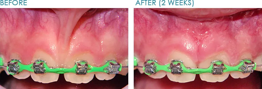 Frenectomy in Wylie TX — tongue-tie and lip-tie release for infants, children and adults at Merry Dental Hub