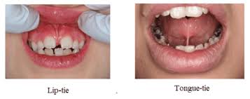 Clinical diagram of buccal and lingual frenum anatomy — frenectomy reference, Merry Dental Hub Wylie TX