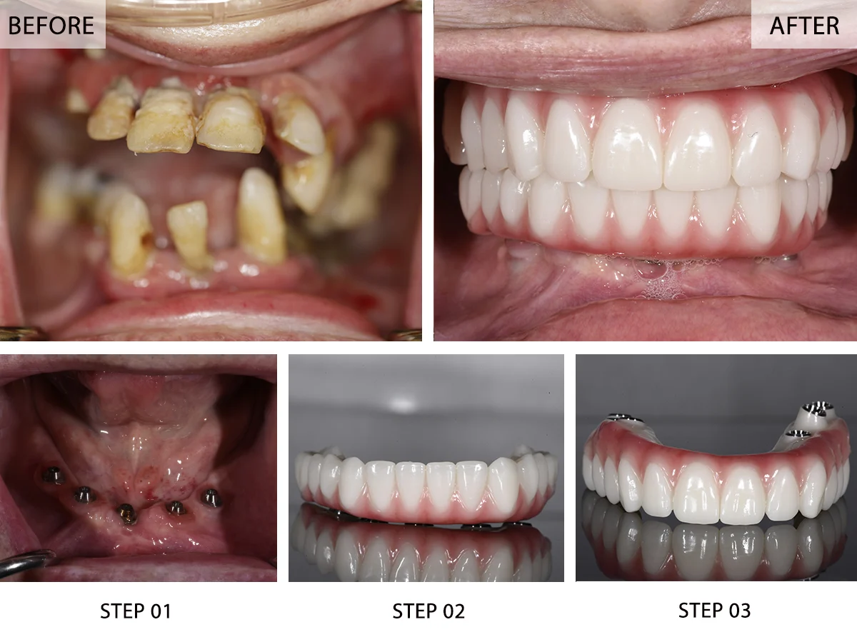 All-on-4 dental implant before and after case at Merry Dental Hub — patient with severely failing teeth (before), panoramic X-ray showing 4 implant posts placed in jaw, All-on-4 prosthesis fabricated, and final beautiful smile result (after) — full arch permanent teeth by UCSF-trained Dr. C DDS in Wylie TX 75098 serving Wylie, Murphy, Sachse, Richardson, Garland TX