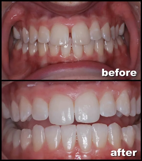 Gap closure diastema before and after clear aligners at Merry Dental Hub Wylie TX — classic central-incisor gap closed in 10 months, no surgery no veneers. Real patient photo.