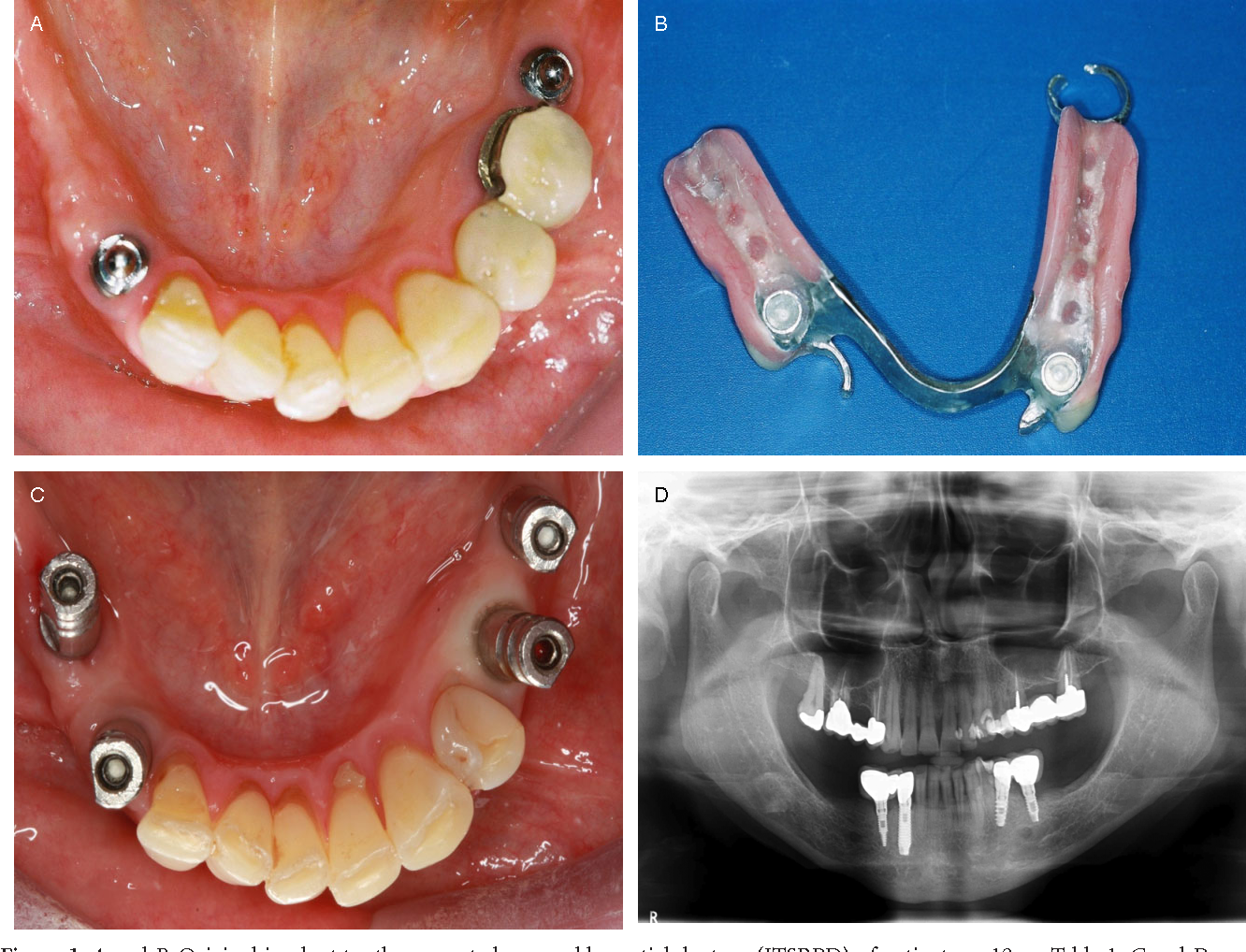 Implant-supported partial denture at Merry Dental Hub — titanium implant posts with snap attachments stabilizing a removable partial denture for multiple scattered missing teeth in Wylie TX 75098, by UCSF-trained Dr. C DDS serving Wylie, Murphy, Sachse, Richardson, Garland, Rowlett TX