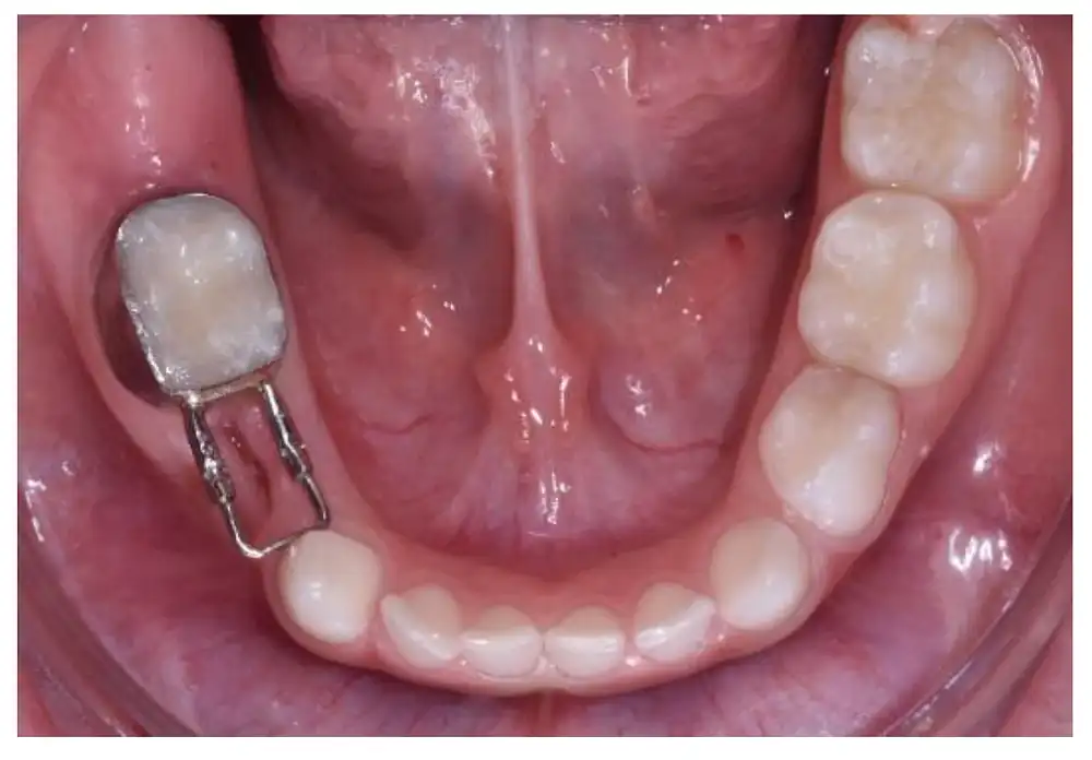 Lingual arch space maintainer in a child's mouth — custom pediatric dental spacer connecting both lower second molars to preserve arch length after early baby tooth loss, placed by Dr. C at Merry Dental Hub, Wylie TX 75098. Bilateral fixed appliance prevents tooth drifting and crowding before permanent teeth erupt.