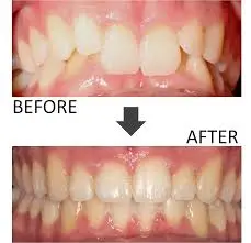 Clear aligner overbite correction before and after at Merry Dental Hub — Invisalign Bite Ramp technology correcting deep overbite in Wylie TX patient