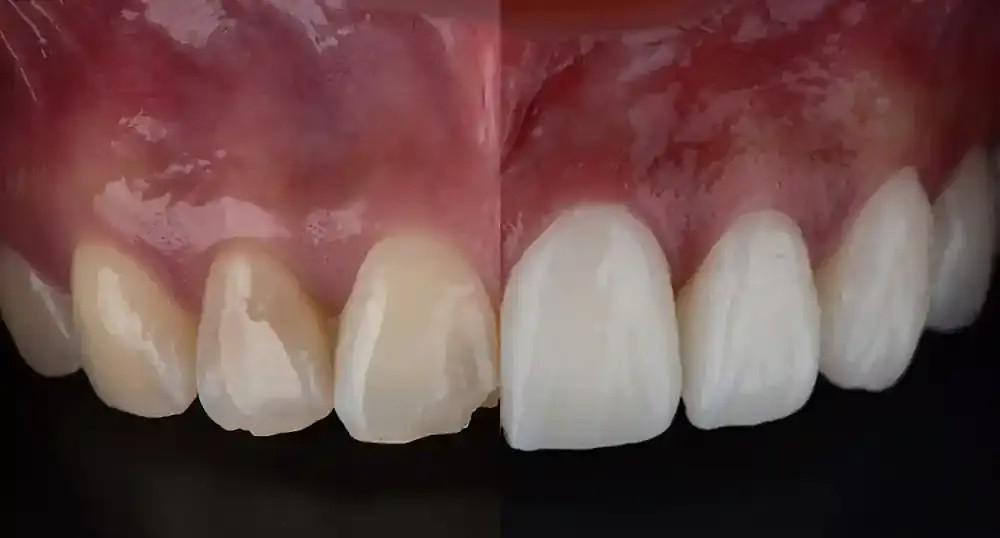 Custom porcelain veneers for a brighter smile at Merry Dental Hub — Wylie TX 75098