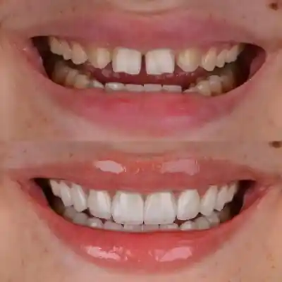 Real porcelain veneers result at Merry Dental Hub — before and after of front teeth restored with custom porcelain veneers by Dr. C, Wylie TX