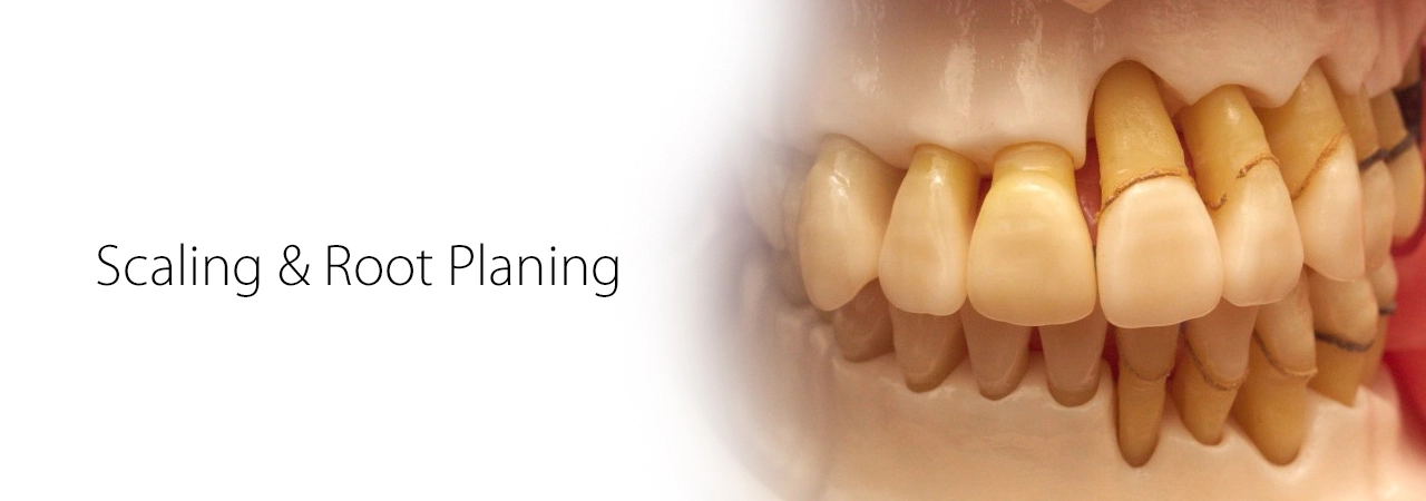 Scaling and root planing deep cleaning for gum disease at Merry Dental Hub — Wylie TX 75098