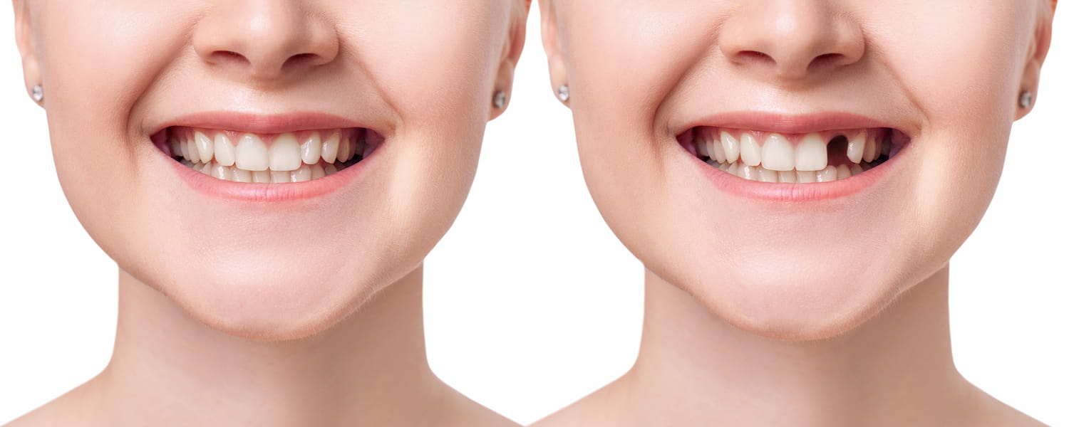 Before and after single dental implant at Merry Dental Hub — patient with one missing tooth (before) next to a complete natural-looking smile restored with a single implant crown (after) — permanent tooth replacement by UCSF-trained Dr. C DDS in Wylie TX 75098 serving Wylie, Murphy, Sachse, Richardson, Garland TX