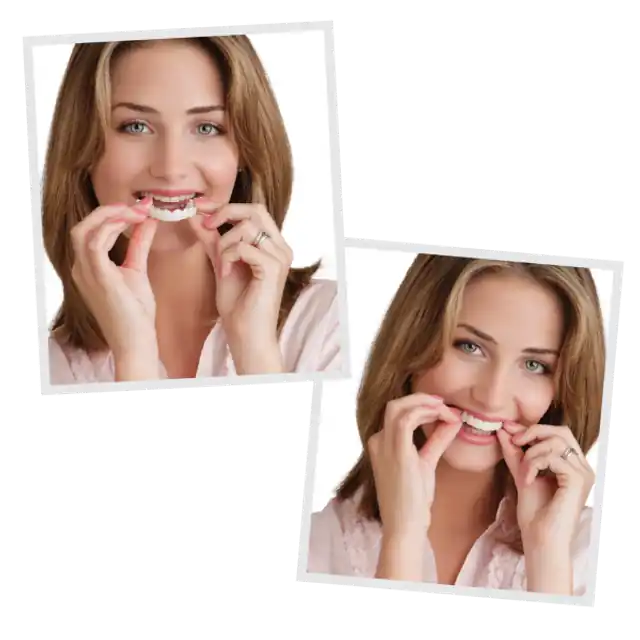 Snap-On Smile removable cosmetic veneers worn by patient in Wylie TX