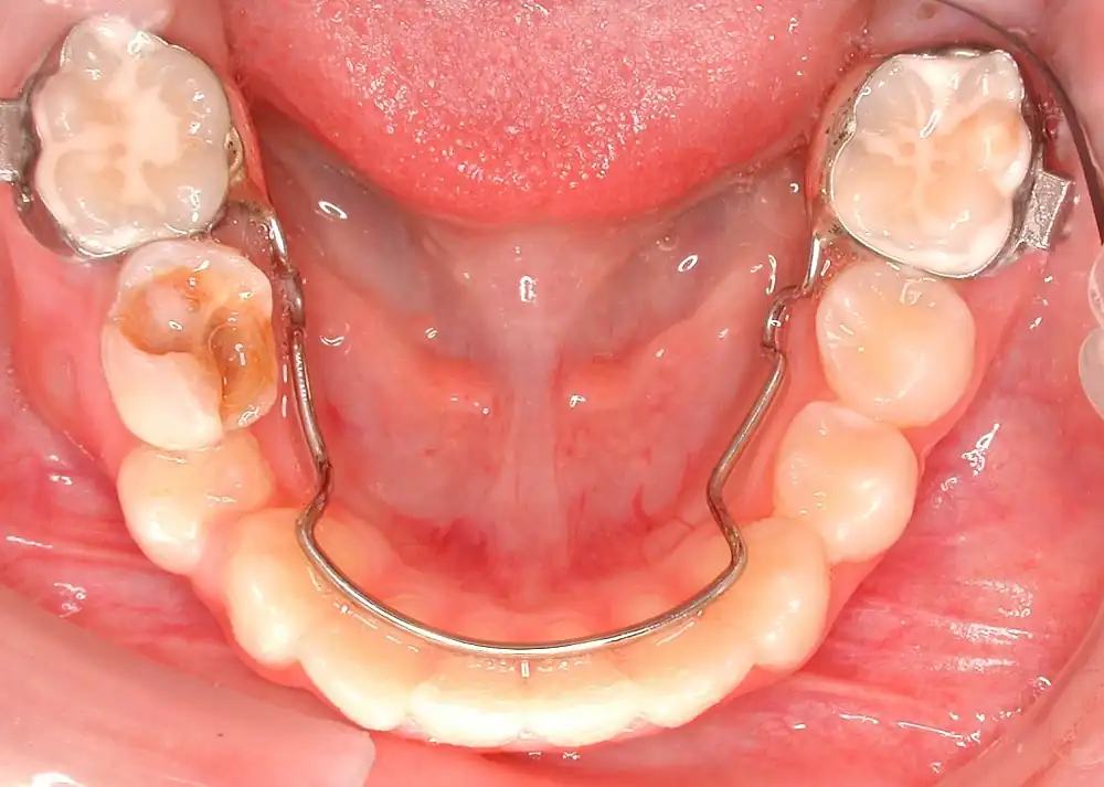 Band-and-loop space maintainer placed on a child's lower molar at Merry Dental Hub — clinical photo of a custom pediatric dental spacer preserving the space for the permanent premolar to erupt, Wylie TX