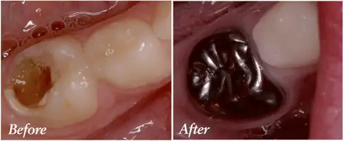 Pediatric pulpotomy result — clinical photo of a baby molar with deep decay (left) and the same tooth restored with a stainless steel crown after pulpotomy (right) at Merry Dental Hub, Wylie TX