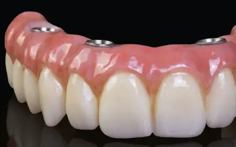 All-on-4 full-arch dental implants in Wylie TX