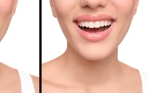 Crown lengthening and gum reshaping in Wylie TX