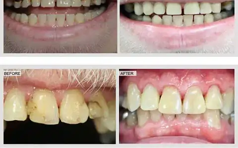 Dental bonding to repair chipped teeth in Wylie TX