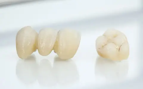 Dental crowns and bridges in Wylie TX