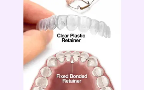 Custom retainers after braces in Wylie TX