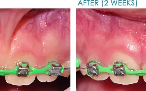 Lip and tongue tie frenectomy in Wylie TX