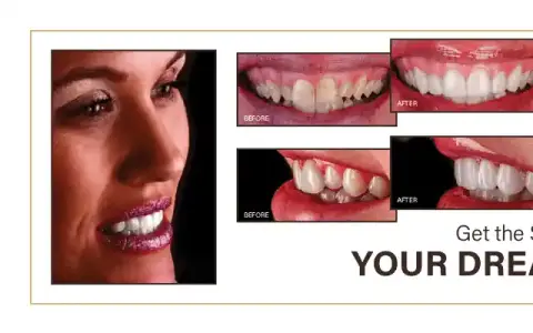 Full-mouth rehabilitation in Wylie TX