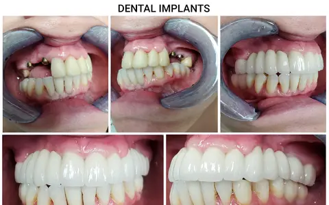 Implant-supported bridge for multiple missing teeth in Wylie TX