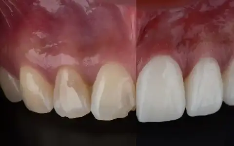 Porcelain veneers in Wylie TX