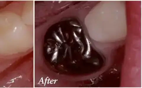 Pulpotomy and stainless steel crowns for kids in Wylie TX