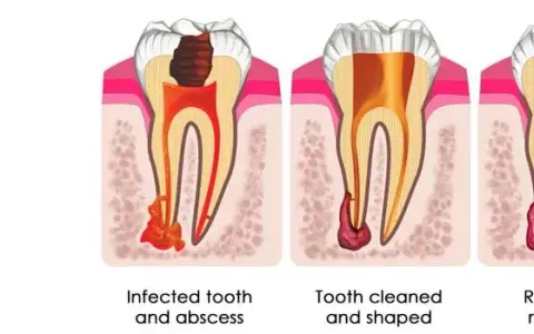 Gentle root canal therapy in Wylie TX