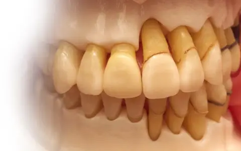 Scaling and root planing for gum disease in Wylie TX