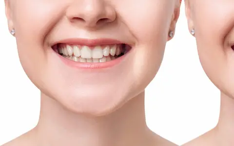 Single dental implant in Wylie TX