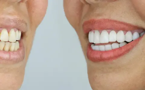 Smile makeover before and after in Wylie TX