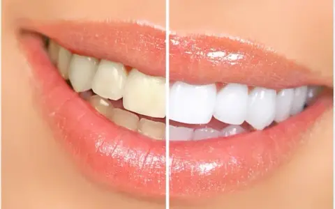 Professional teeth whitening in Wylie TX