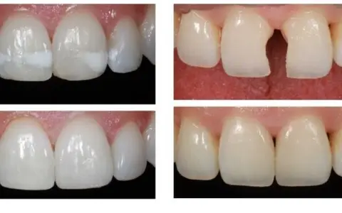 Tooth-colored composite fillings in Wylie TX