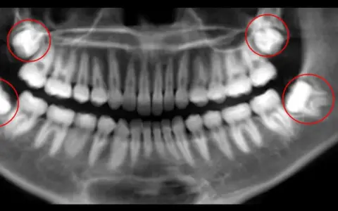 Wisdom teeth removal in Wylie TX