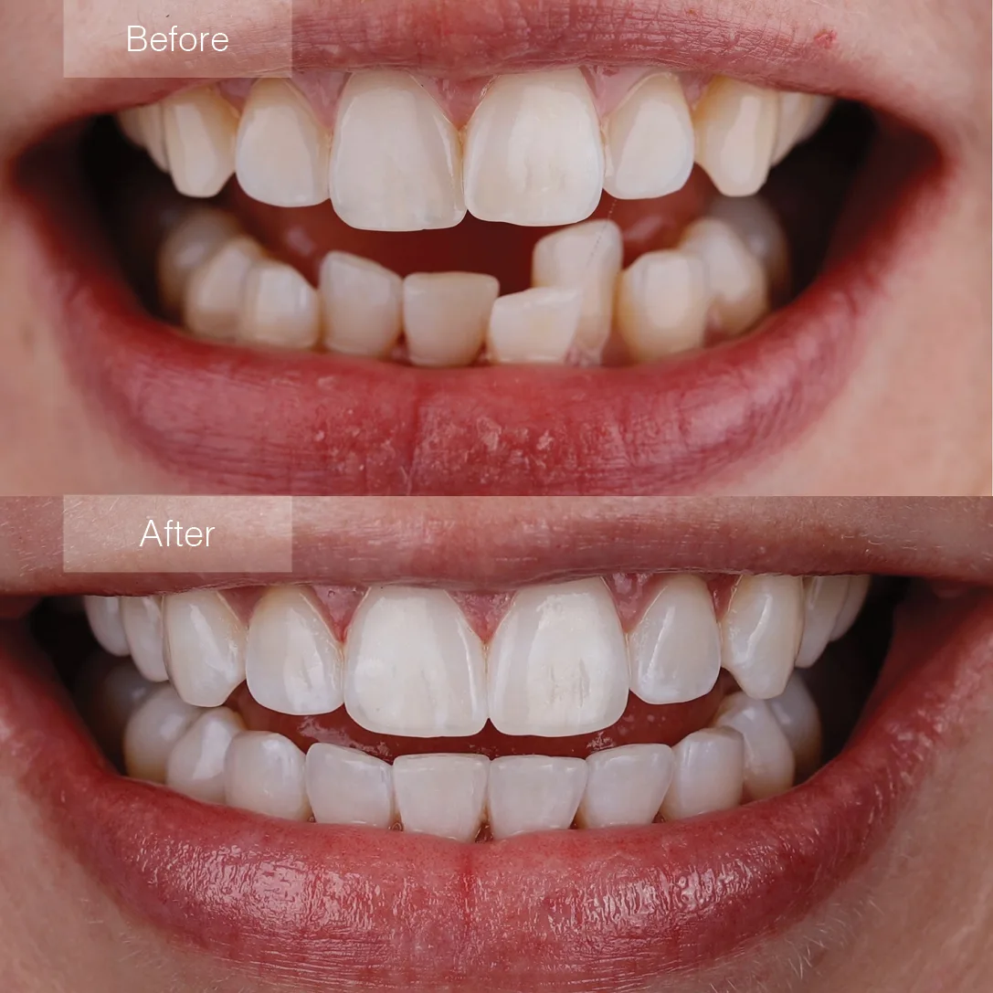 Teen clear aligner before and after at Merry Dental Hub Wylie TX — crowded and misaligned teeth corrected with clear aligners, real patient result. Serving Murphy, Sachse & Richardson TX.