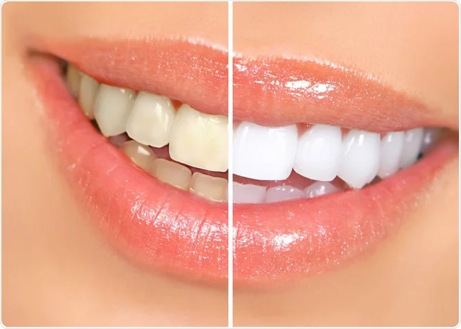 Clear aligner treatment completion and free professional whitening result at Merry Dental Hub — straight and bright smile after Invisalign in Wylie TX
