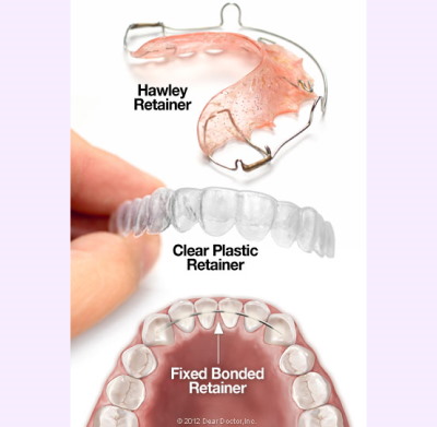 Three types of retainers at Merry Dental Hub: Essix clear retainer, Hawley wire retainer, and permanent bonded retainer — Wylie TX 75098